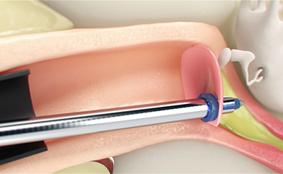 Device placing tube