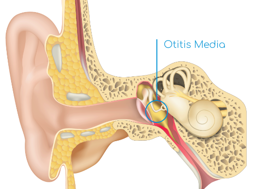Otitis Media